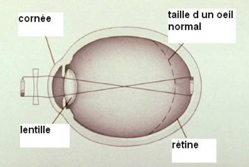 Correction de la Myopie