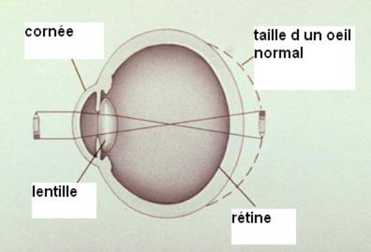 L'Hypermetropie