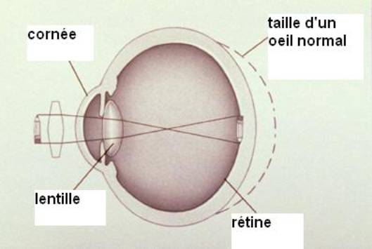 Verres correcteurs