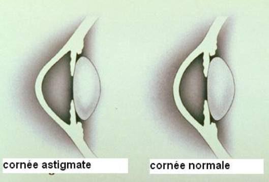 Correction de l'astigmatie