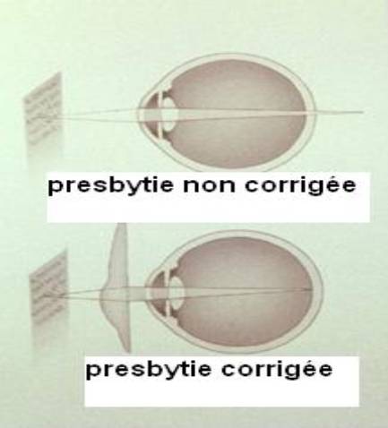 Correction de la presbytie